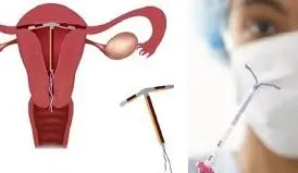 Pasang KB Spiral Atau IUD Rp 250.000